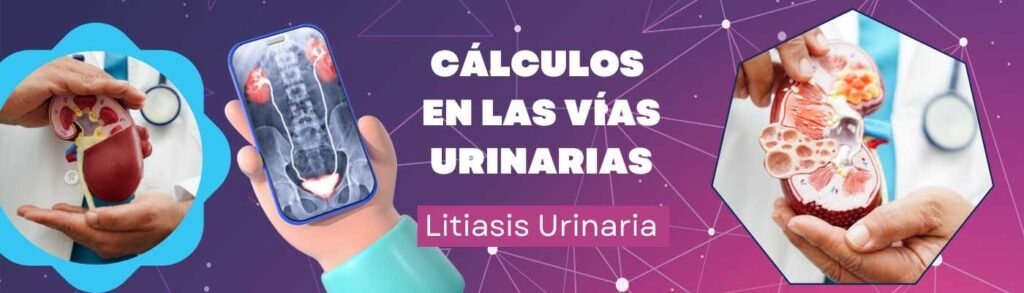 Cálculos En Las Vías Urinarias: Litiasis Urinaria