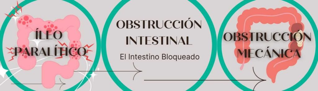 Obstrucción Intestinal: El Intestino Bloqueado